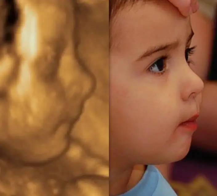 胎儿“四维照“很丑，生后会否也很丑？6张图告诉你答案，太真实