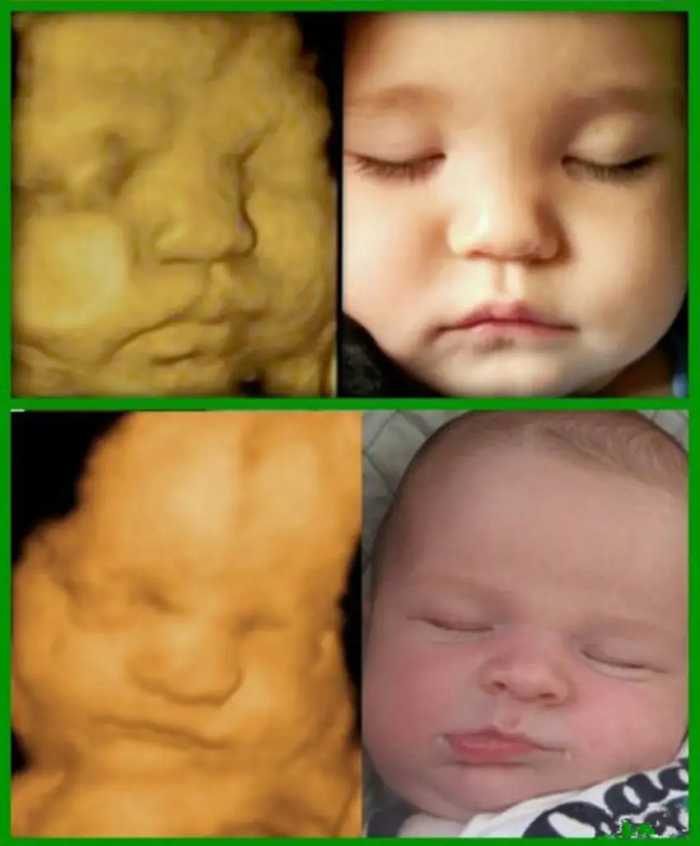出生前 vs 出生后，胎儿四维B超影像与宝宝出生后对比，太神奇