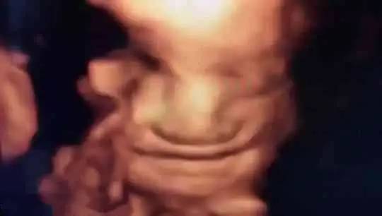 怀孕5个半月做四维彩超，看到胎儿咧嘴微笑，孕妇既惊喜又惊讶